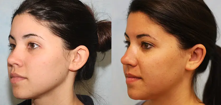 Otoplasty (Ear Pinning Surgery) Patient 2 Image 1