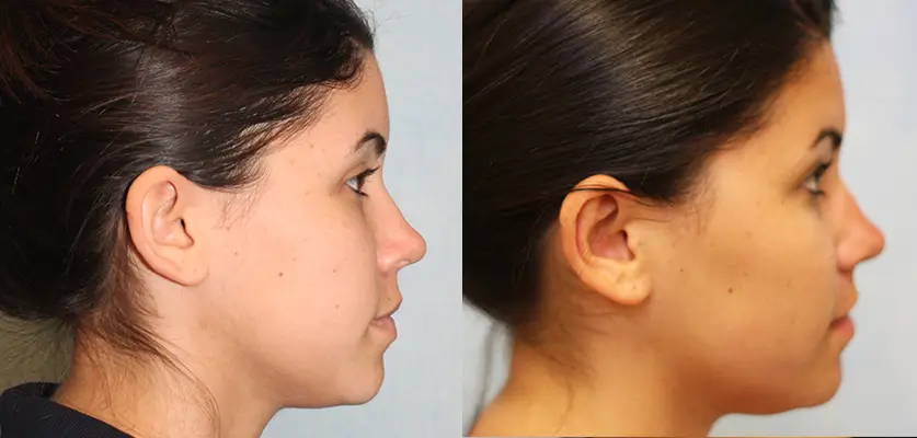 Otoplasty (Ear Pinning Surgery) Patient 2 Image 2