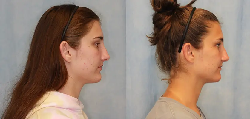 Otoplasty (Ear Pinning Surgery) Patient 3 Image 1