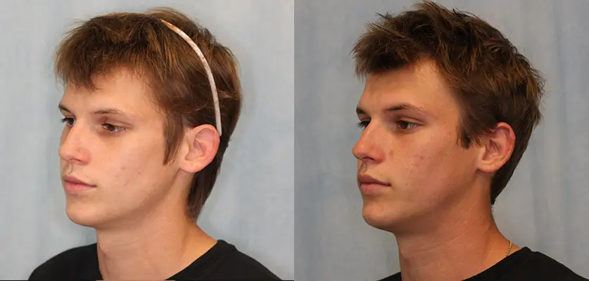 Otoplasty (Ear Pinning Surgery) Patient 4 Image 1