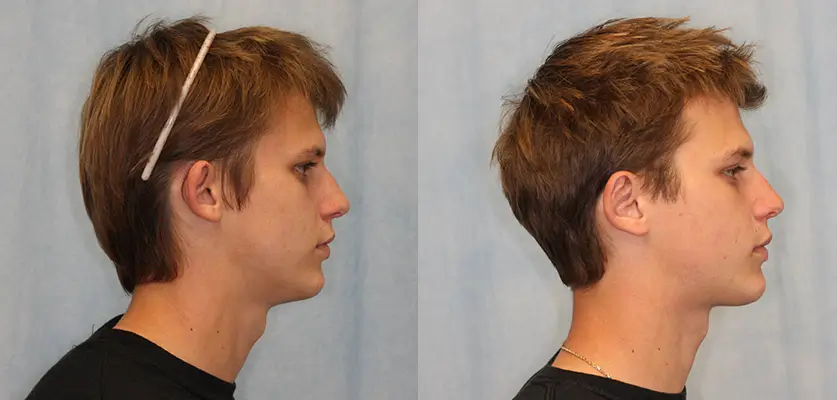 Otoplasty (Ear Pinning Surgery) Patient 4 Image 2