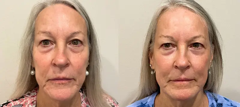 CO2 Laser Resurfacing Patient 7 Image 0