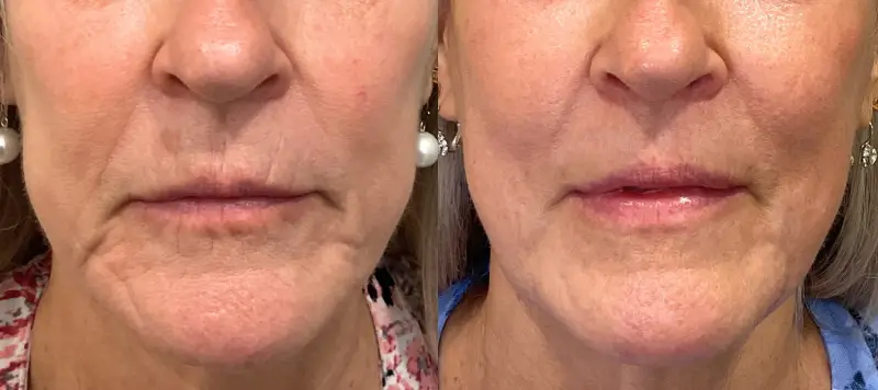 CO2 Laser Resurfacing Patient 7 Image 1