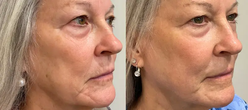 CO2 Laser Resurfacing Patient 7 Image 2
