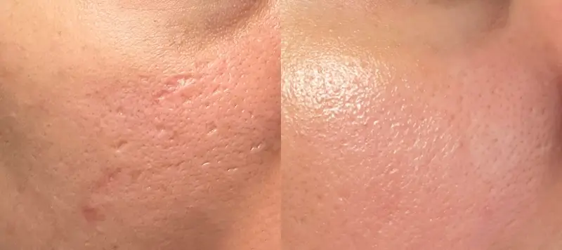 CO2 Laser Resurfacing Patient 7 Image 3
