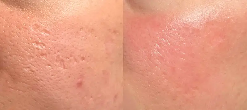CO2 Laser Resurfacing Patient 7 Image 4