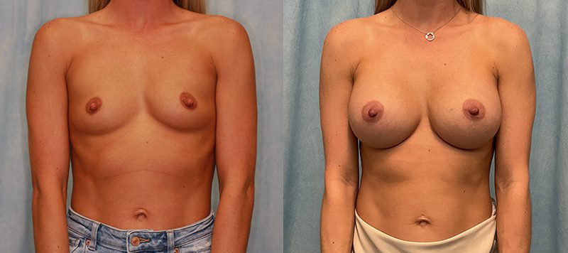 Breast Augmentation Patient 26 Image 0