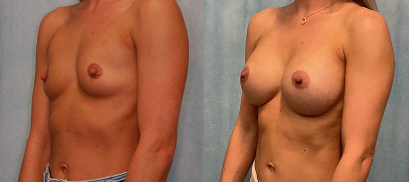 Breast Augmentation Patient 26 Image 1