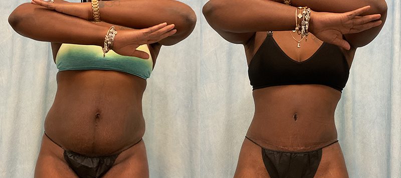 Abdominoplasty Patient 18 Image 2