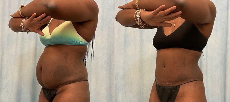 Abdominoplasty Patient 18 Image 4
