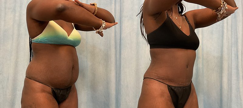 Abdominoplasty Patient 18 Image 6