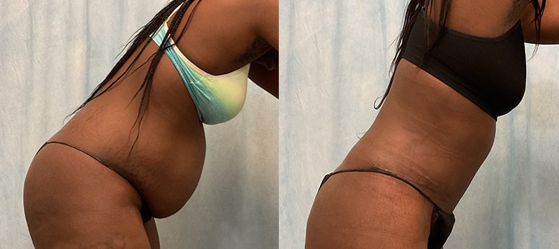 Abdominoplasty Patient 18 Image 1