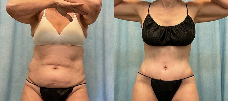 Abdominoplasty Patient 19 Image 3