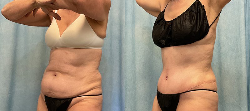 Abdominoplasty Patient 19 Image 0