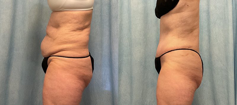 Abdominoplasty Patient 19 Image 1