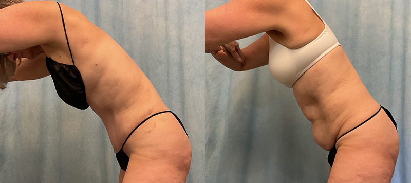 Abdominoplasty Patient 19 Image 2