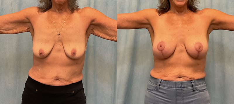 Breast Augmentation Patient 27 Image 0