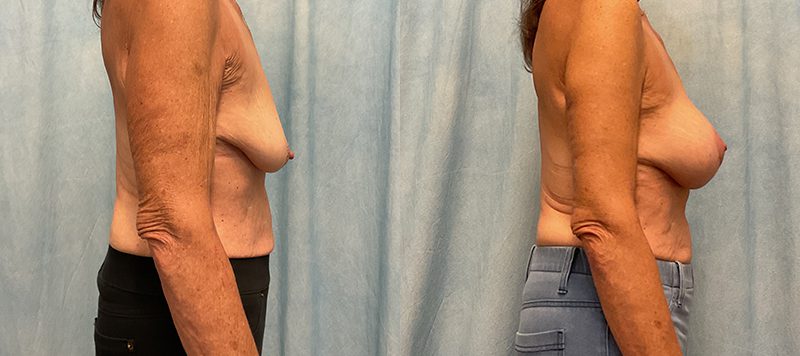 Breast Augmentation Patient 27 Image 2