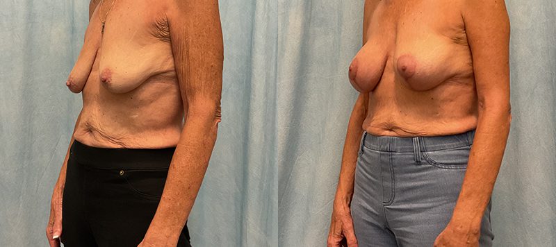 Breast Augmentation Patient 27 Image 3