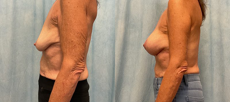 Breast Augmentation Patient 27 Image 1