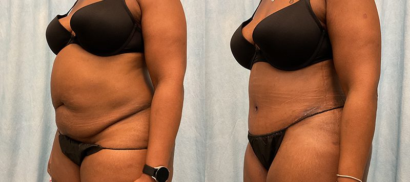 Abdominoplasty Patient 20 Image 3