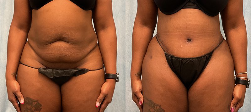 Abdominoplasty Patient 20 Image 4