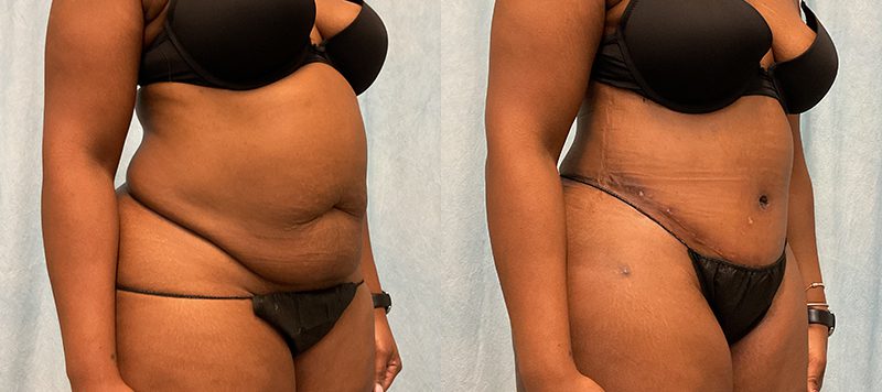 Abdominoplasty Patient 20 Image 1