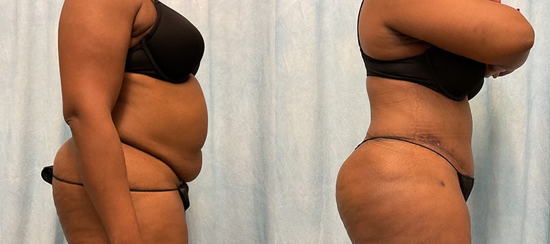 Abdominoplasty Patient 20 Image 2