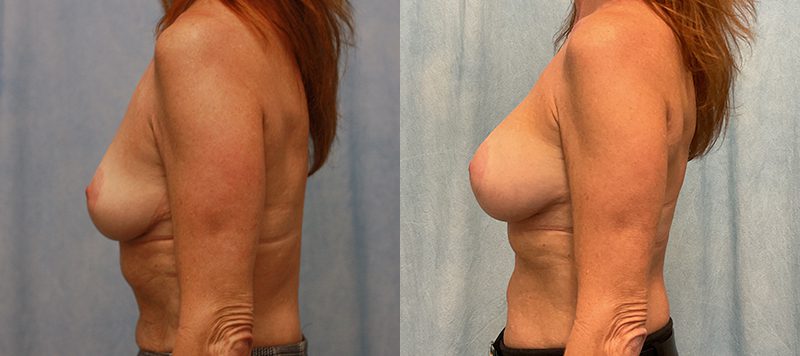 Breast Augmentation Patient 28 Image 0