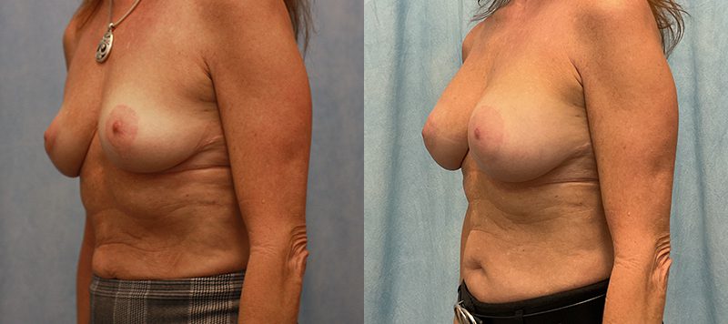 Breast Augmentation Patient 28 Image 1