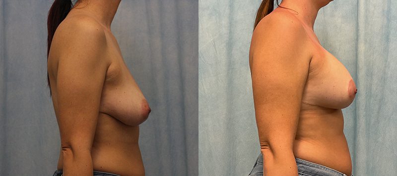 Breast Augmentation Patient 29 Image 4