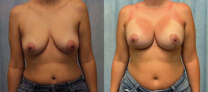 Breast Augmentation Patient 29 Image 1