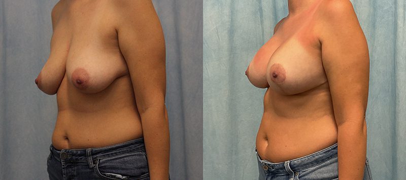 Breast Augmentation Patient 29 Image 2