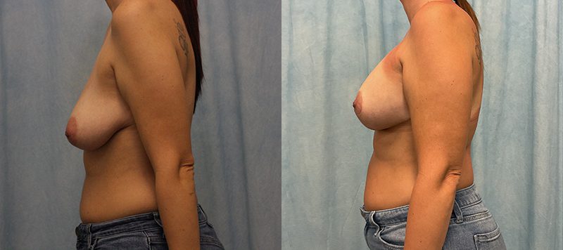Breast Augmentation Patient 29 Image 3