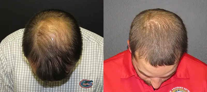 Neograft Patient 1 Image 0