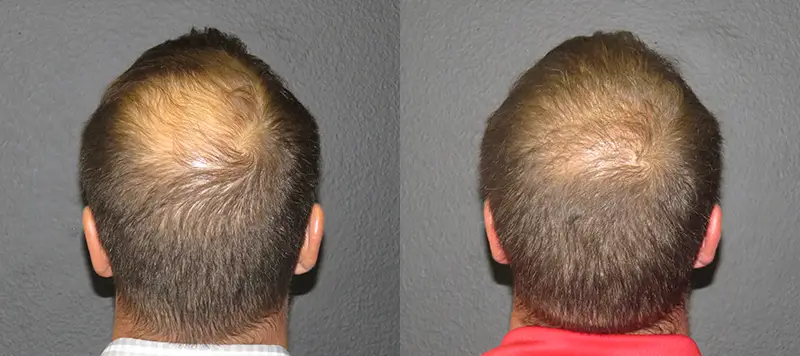 Neograft Patient 1 Image 3