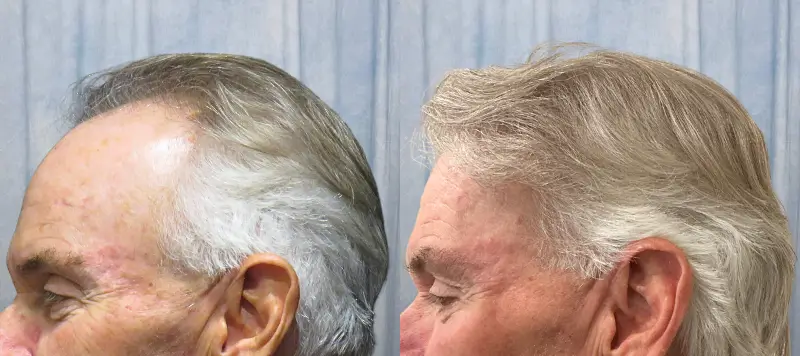 Hair Restoration Patient 5 Image 1