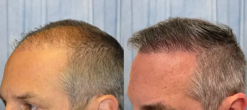 Hair Restoration Patient 2 Image 1