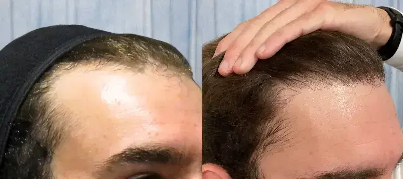Hair Restoration Patient 3 Image 0