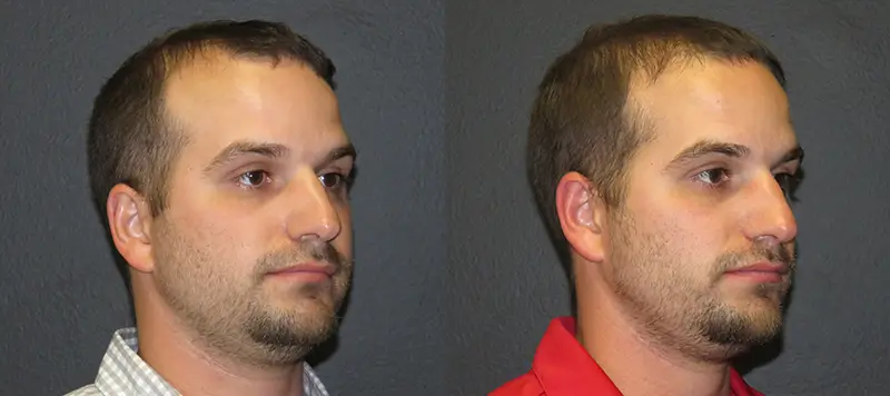 Hair Restoration Patient 1 Image 2