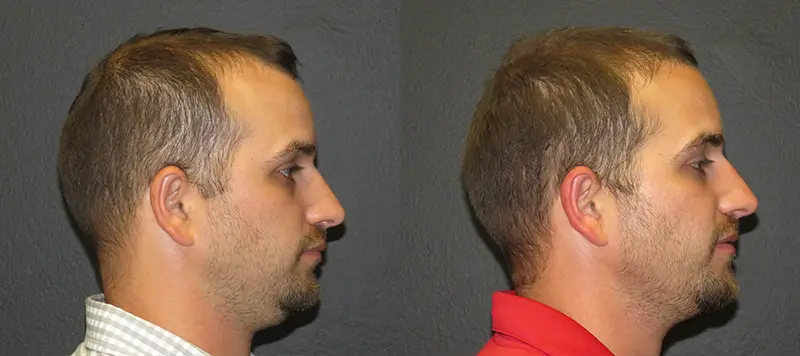 Hair Restoration Patient 1 Image 3