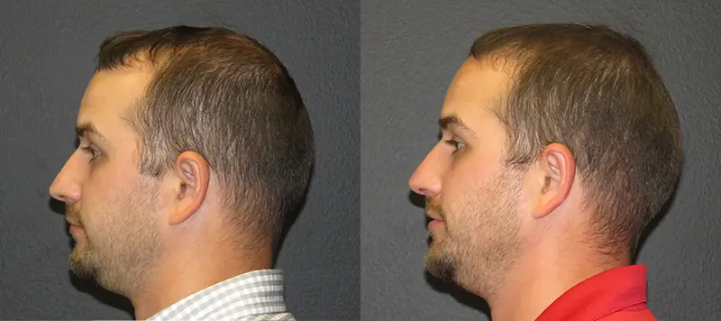 Hair Restoration Patient 1 Image 4