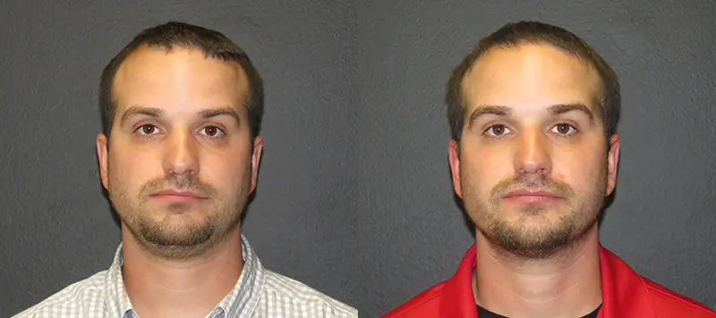 Hair Restoration Patient 1 Image 6