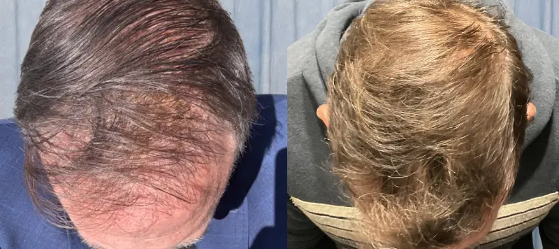 Hair Restoration Patient 7 Image 1