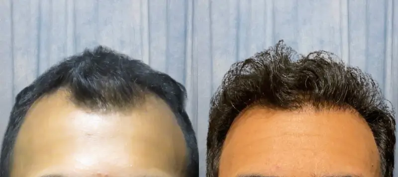 Hair Restoration Patient 6 Image 1